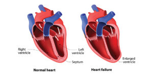 Using Machine learning to Predict Heart Failure